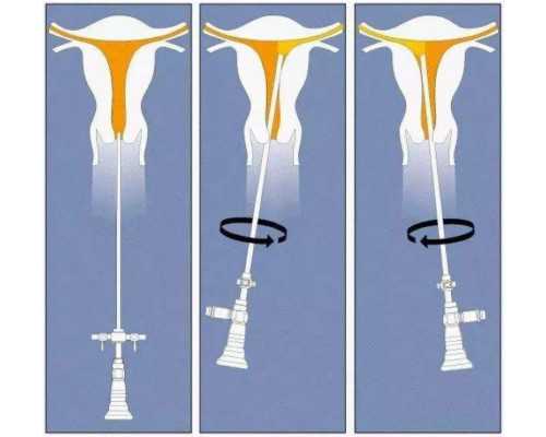 子宫腺肌症对备孕的影响及助孕策略